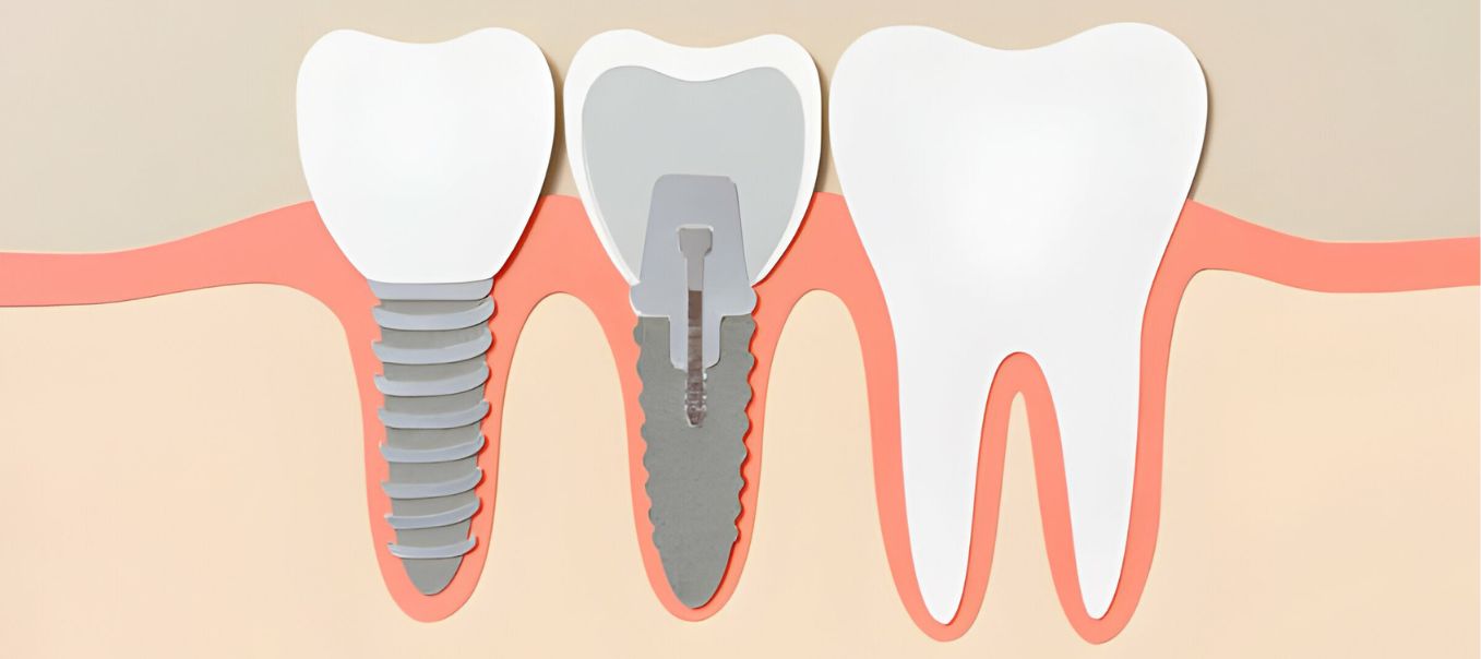 Dental Implant Crowns