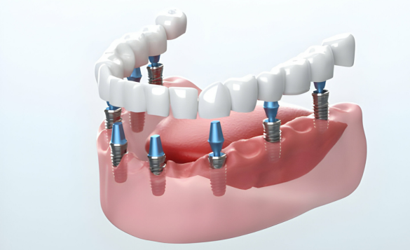 Dental Implant Crown Materials
