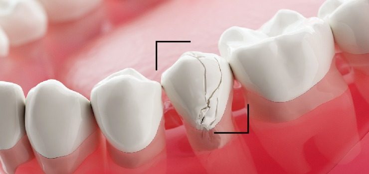 Dental Glue for Crowns