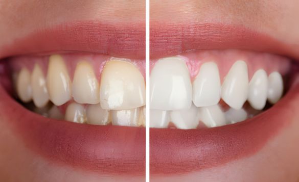 Dental Bonding Before and After