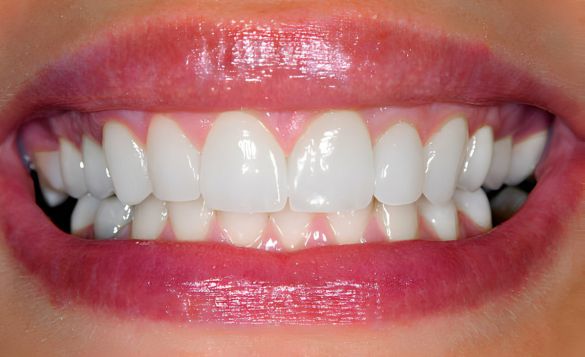 Dental Crown Front Tooth