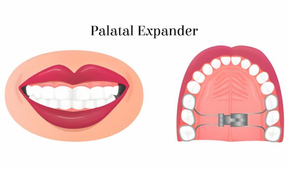 Dental Expander