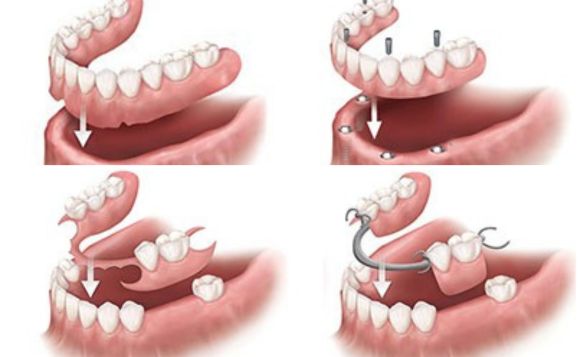 Partial Dentures Before and After
