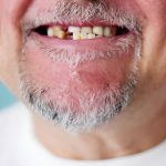 Tooth Implant vs Dental Bridge