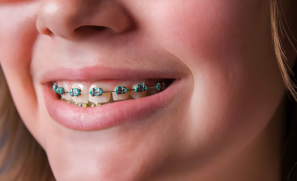 What are Green Braces?