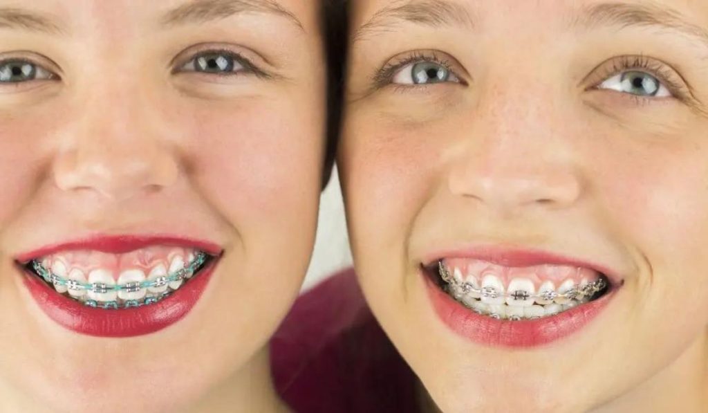 How to Care for Green Braces