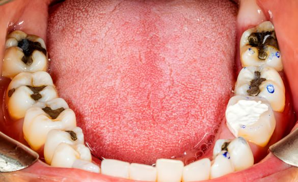 Causes of Cavities
