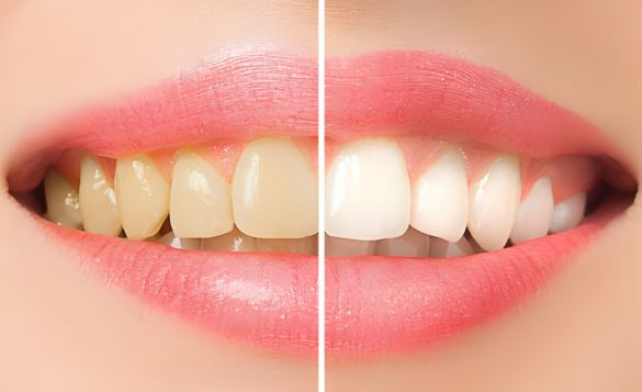 Dentures: Preparing for Your Consultation