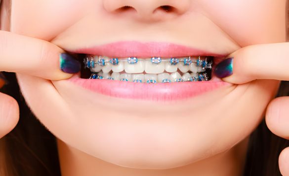 braces color