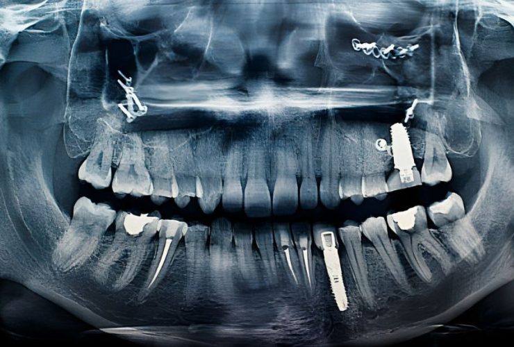 Are Teeth Bones
