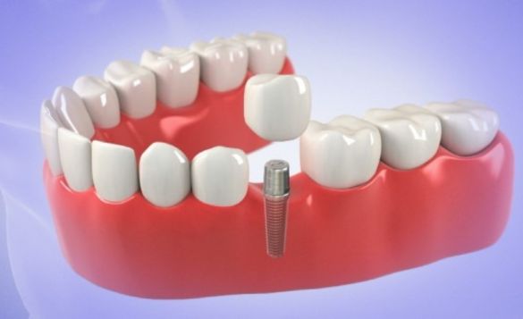 How Much is a Dental Implant
