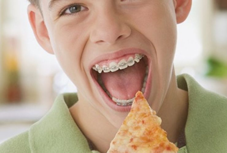 Soft Foods for Braces
